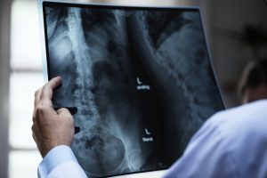 How to Find the Best Spinal Cord Injury Lawyer
