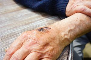New Bedford Scarring Claim Lawyer | How Much is My Claim Worth?