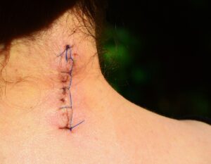 Assessing the Value of Your Claims with a Providence Scarring Claims Lawyer