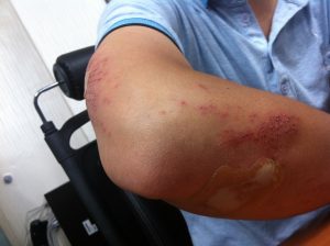 Should You Handle Your Personal Injury Claim or Hire a Worcester Personal Injury Lawyer?